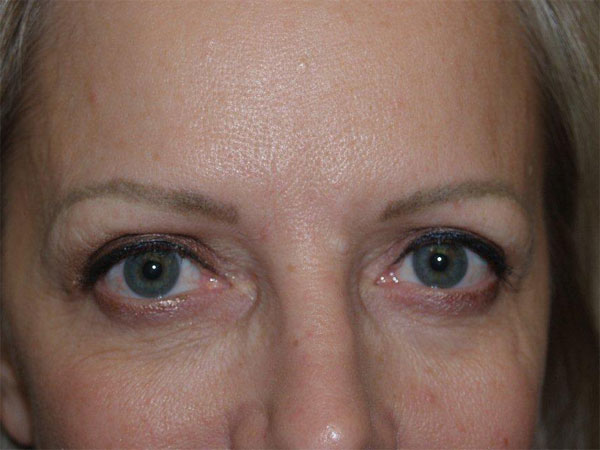 eyebrow and eyelashes - patient 82 - before 1