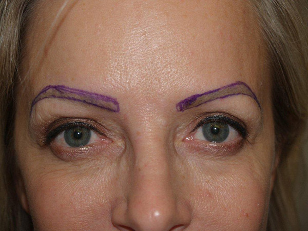eyebrow and eyelashes - patient 82 - before marked 1