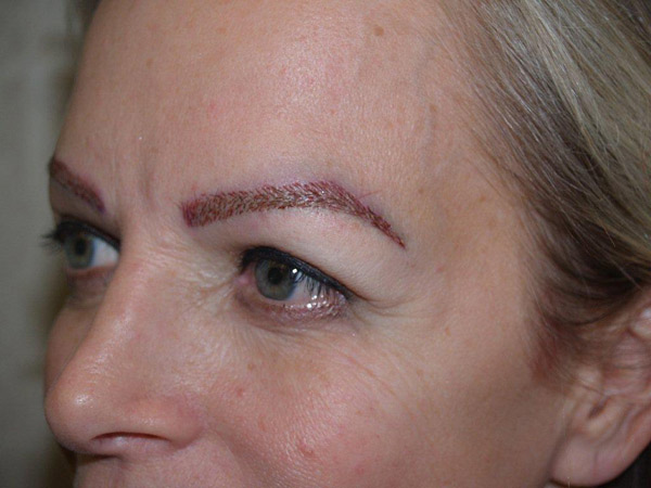 eyebrow and eyelashes - patient 82 - after immediately 2