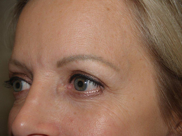 eyebrow and eyelashes - patient 82 - before 2
