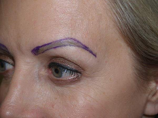 eyebrow and eyelashes - patient 82 - before marked 2