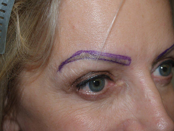 eyebrow and eyelashes - patient 82 - before marked 3