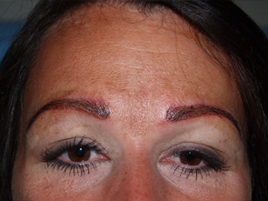eyebrow and eyelashes - patient 110 - after immediately 1