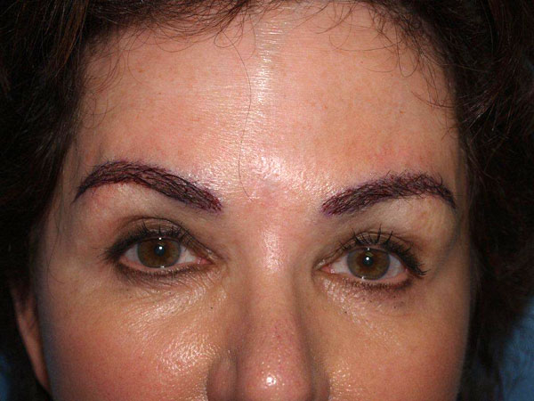 eyebrow and eyelashes - patient 83 - after immediately 1