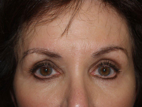 eyebrow and eyelashes - patient 83 - after 1