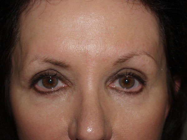 eyebrow and eyelashes - patient 83 - before 1