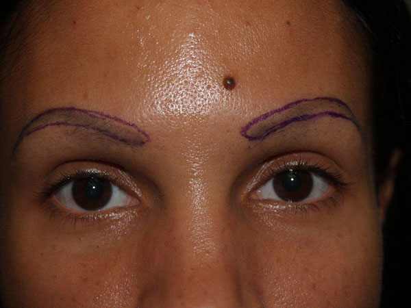 eyebrow and eyelashes - patient 69 - before 1