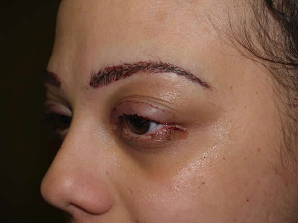 eyebrow and eyelashes - patient 66 - after 2