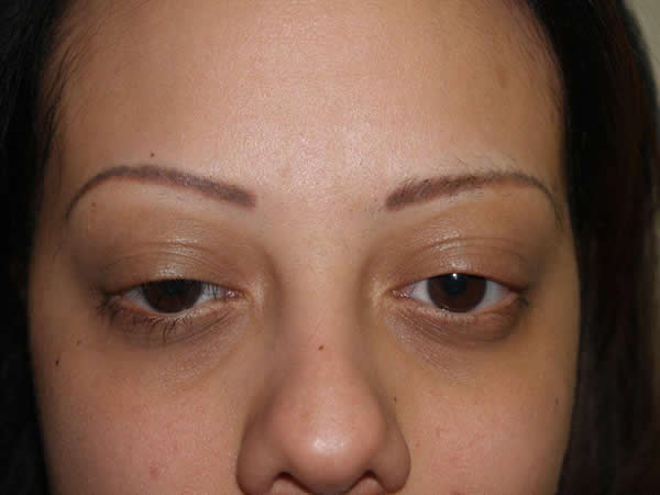 eyebrow and eyelashes - patient 66 - before 1