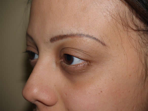eyebrow and eyelashes - patient 66 - before 2