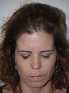 Miami, Fl. Follicular Unit Micrografting Photo - Patient 1 - After 1