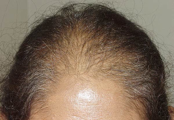 follicular unit micrografting - patient 10 - before 2