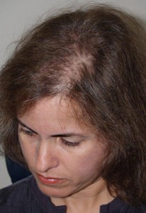  Follicular Unit Micrografting Photo - Patient 1 - Before 2