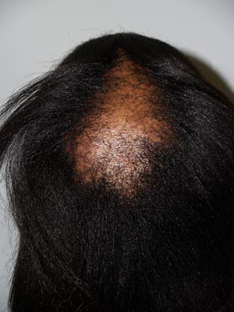 follicular unit micrografting - patient 50 - before 2