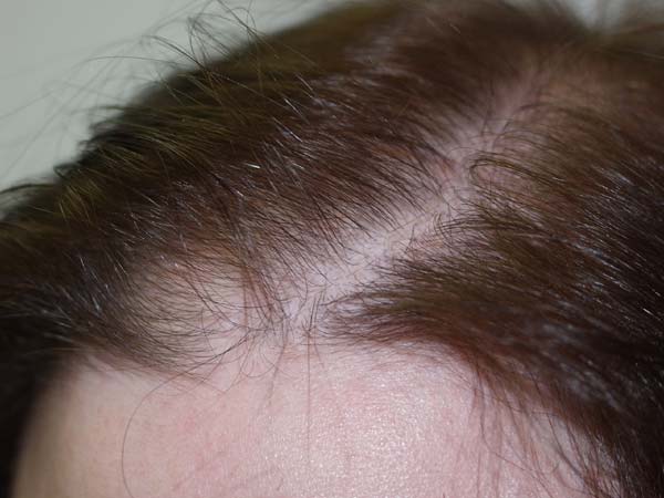 follicular unit micrografting - patient 40 - before 2