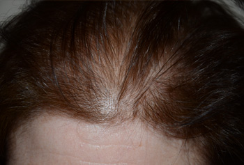 follicular unit micrografting - patient 98 - before 3
