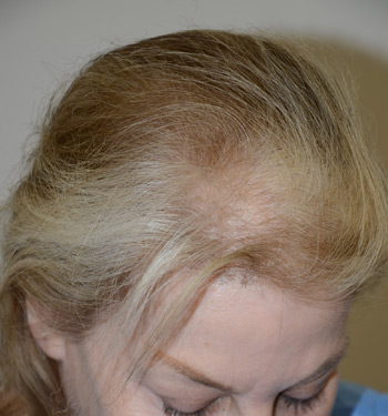 follicular unit micrografting - patient 99 - before 3