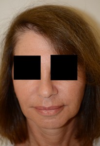 Miami, Fl Follicular Unit Micrografting Photo - Patient 1 - After 1