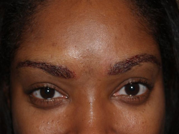 eyebrow transplant - patient 46 - after 1