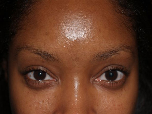 eyebrow transplant - patient 46 - before 1