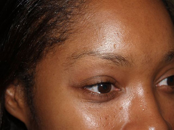 eyebrow transplant - patient 46 - before 3