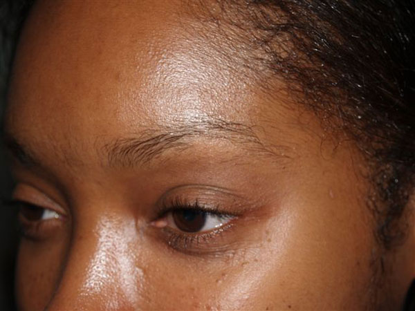eyebrow transplant - patient 46 - before 2