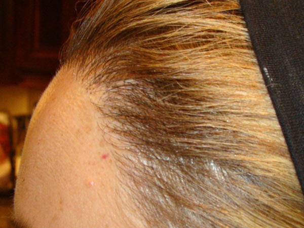 hairline advancement - patient 26 - after 2