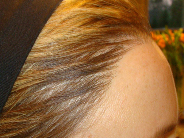 hairline advancement - patient 26 - after 1