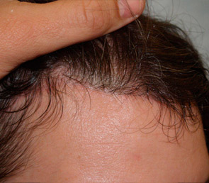 hairline advancement - patient 39 - after 4