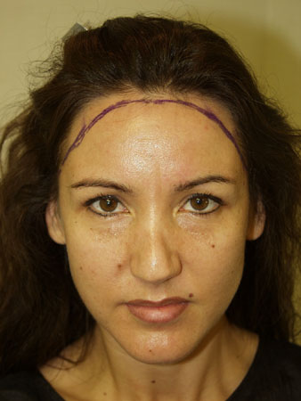 hairline advancement - patient 27 - before marked 1