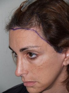 Miami, Fl Hairline Advancement Photo - Patient 1 - Before 2