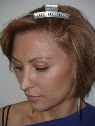 hairline advancement - patient 30 - after 4
