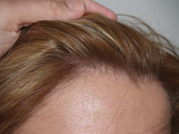 hairline advancement - patient 30 - after 5