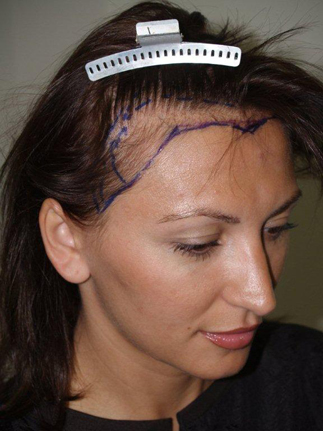 hairline advancement - patient 30 - before marked 1
