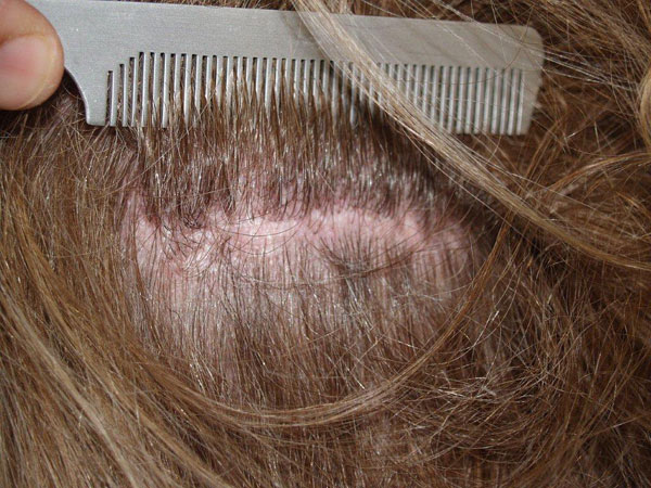 hairline advancement - patient 31 - after 6