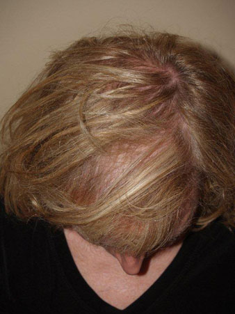 hairline advancement - patient 31 - after 4