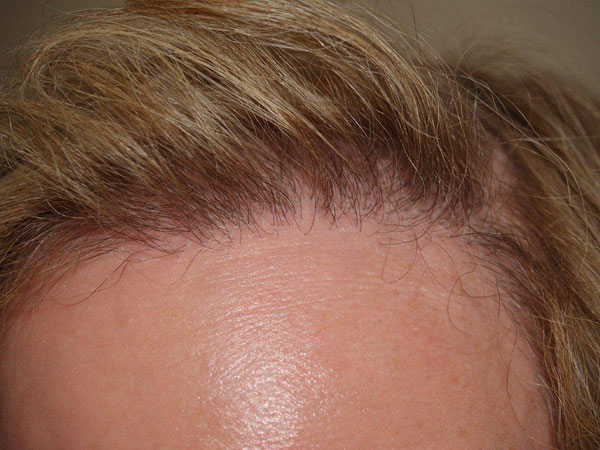 hairline advancement - patient 31 - after 5