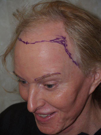 hairline advancement - patient 31 - before marked 1