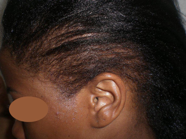 hairline advancement - patient 32 - after 1