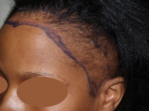 Miami, Fl Hairline Advancement Photo - Patient 1 - Before 1