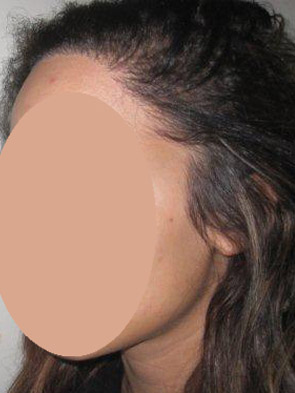 hairline advancement - patient 38 - after 2