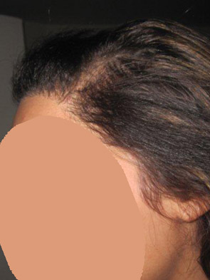 hairline advancement - patient 38 - after 3
