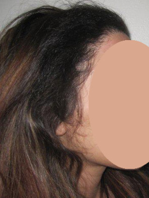 hairline advancement - patient 38 - after 1