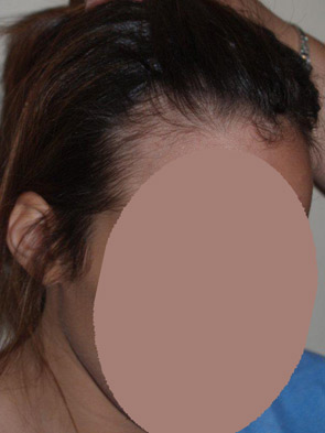 hairline advancement - patient 38 - before 1