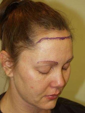 hairline advancement - patient 15 - before marked 1