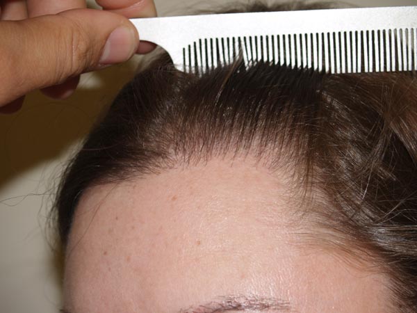 hairline advancement - patient 15 - after 4