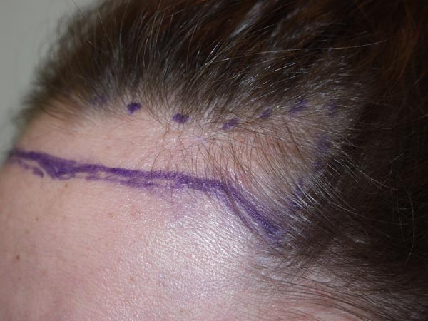 hairline advancement - patient 15 - before marked 3