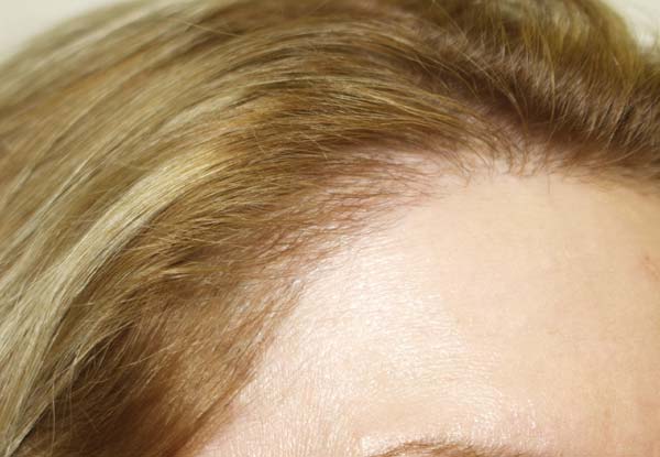 hairline advancement - patient 10 - after 3