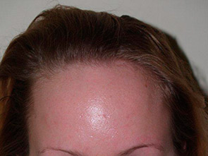 hairline advancement - patient 12 - before 1