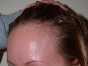 hairline advancement - patient 12 - before 3